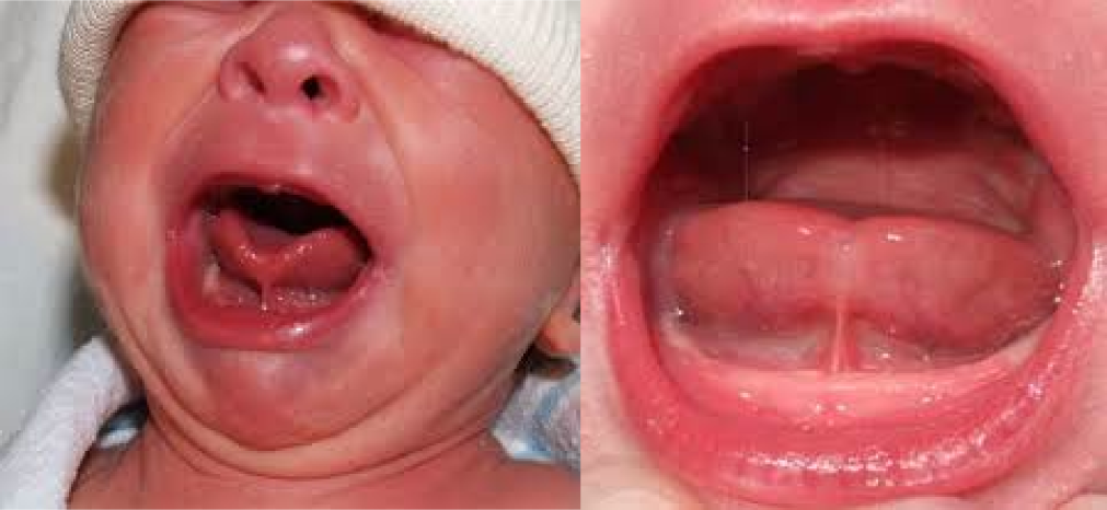 anquiloglossia