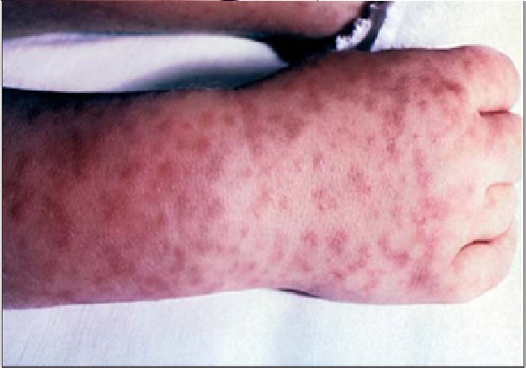febre maculosa sintoma